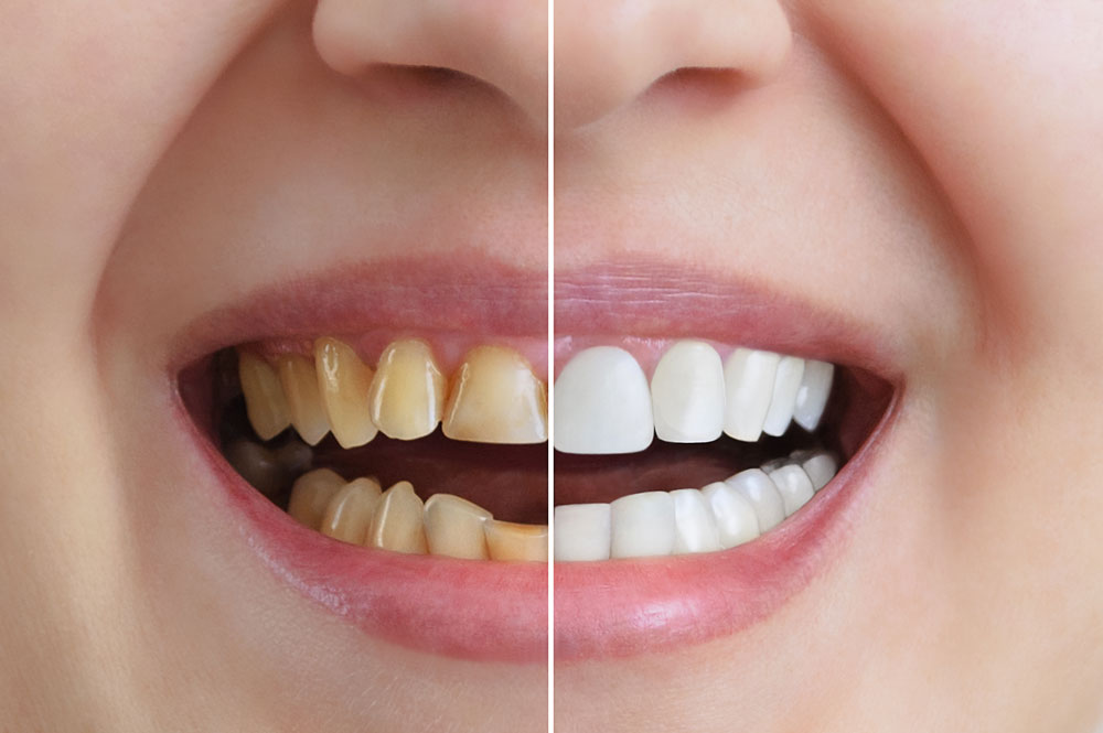 Greenwood Village aesthetic botox treatments at Village Dental